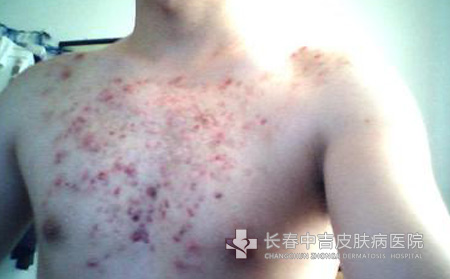 痤疮症状
