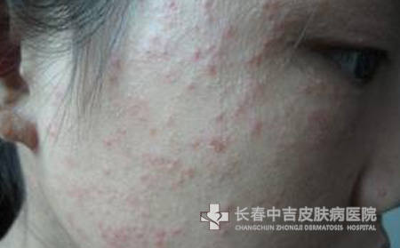 痤疮症状