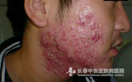 痤疮症状