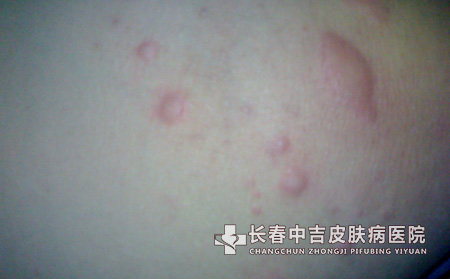 荨麻疹症状
