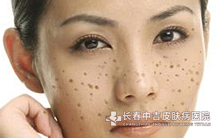 雀斑危害