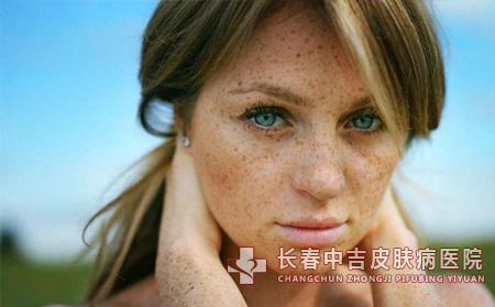 雀斑危害