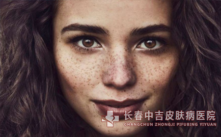 雀斑的危害