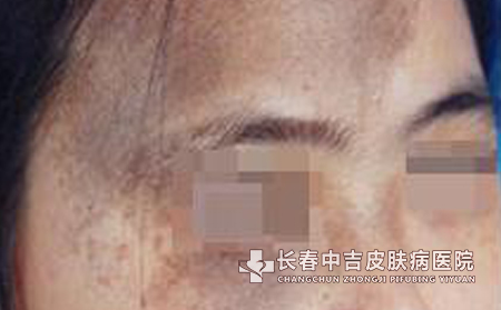 太田痣危害