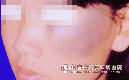 太田痣危害