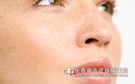 雀斑保健