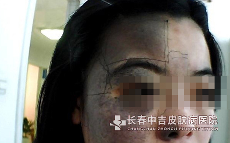 太田痣常见的并发症