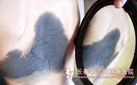 太田痣的易发人群是哪些?
