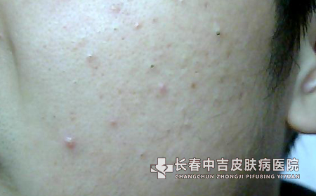 护理青春痘之夏季青春痘的护理方法