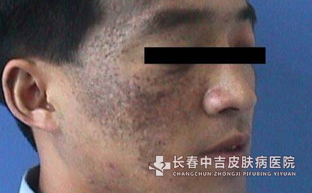 太田痣术后,术后保健,太田痣保健