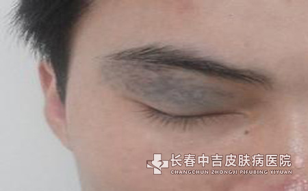 太田痣的危害有哪些呢?