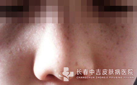 长春女性诱发大范围雀斑后会带来哪些危害