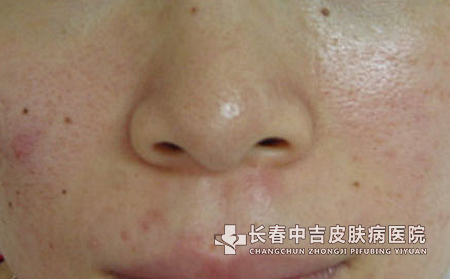 已有雀斑的患者该如何进行自我护理