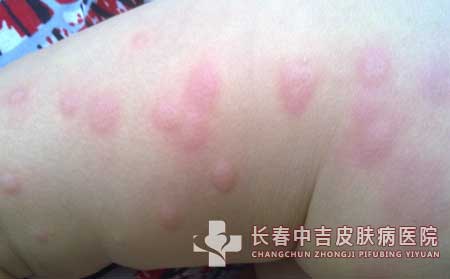 荨麻疹