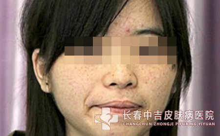 长春中吉皮肤病医院雀斑护理常识说明
