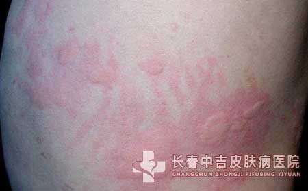 荨麻疹与皮肤过敏