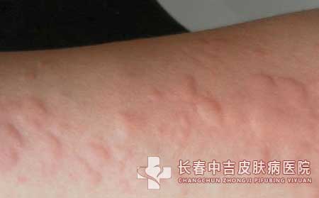 患有荨麻疹后的典型症状表现有哪些？