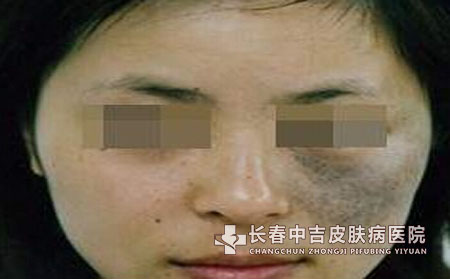 长春太田痣的常有症状身体危害有哪些