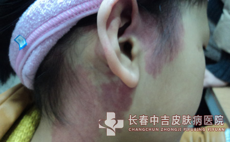 胎记专业医院长春哪里合适
