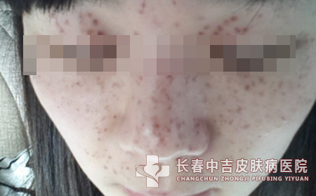 雀斑危害