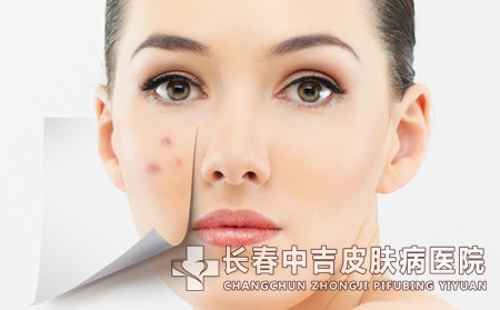 痤疮的临床表现