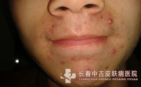 长春治疗青春痘的医院哪家合适