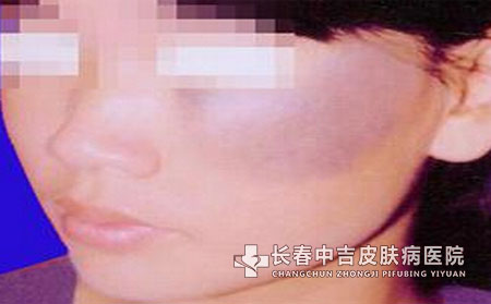 长春中吉皮肤病医院介绍太田痣有哪些症状特点