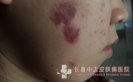 长春看胎记治疗医院排名