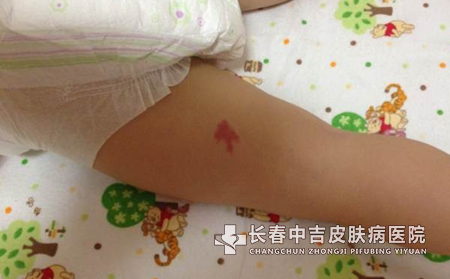 如何科学了解太田痣危害