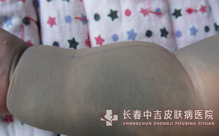 宝宝有胎记会自己消失吗