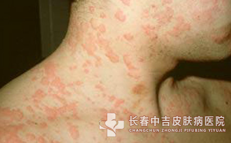 儿童皮肤瘙痒过敏要怎么办呢？