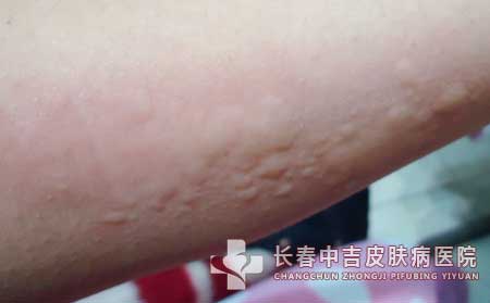 荨麻疹发病有什么特点呢？