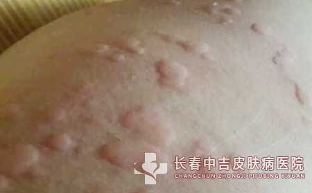 荨麻疹这种疾病会复发吗？