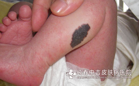 婴儿身上的太田痣能去掉吗