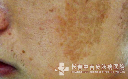 脸上长了雀斑应该如何进行饮食