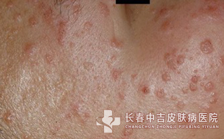长春哪家医院治疗扁平疣效果合适呢？