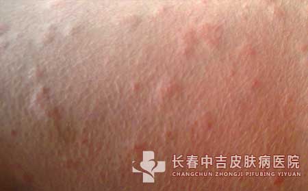 长春有哪家医院治疗荨麻疹效果比较不错?