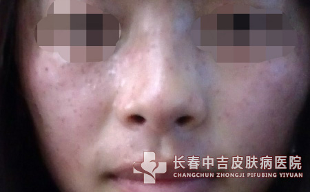 雀斑是有哪些内外部原因引起上哪合适看