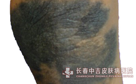 得了太田痣会有什么表现症状呢？