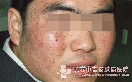 雀斑形成原因有哪些