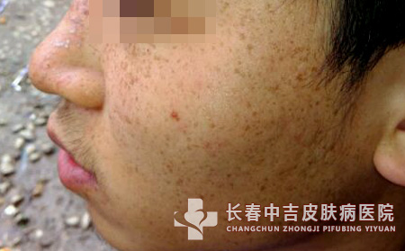 手上有雀斑想外出游玩有哪些事项需要注意哪里治疗