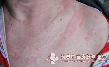 荨麻疹这种皮肤病是不是很难治？