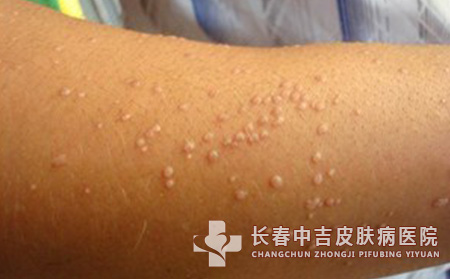 得了扁平疣在日常生活中如何护理
