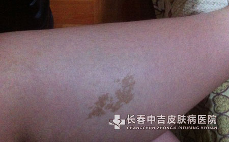 太田痣初期的常见症状有哪些