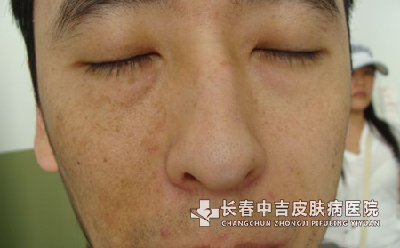 患者要多加留意太田痣的症状表现