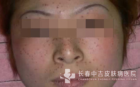 脸上有雀斑夏季要怎样防护合适呢？