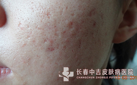 怎样能够预防脸上痤疮复发呢？