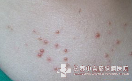 扁平疣对患者的日常生活造成的危害是什么