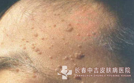 得了扁平疣在饮食方面需要注意什么