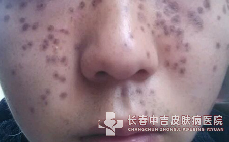 雀斑护理方法主要有哪些